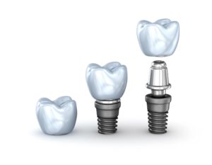 3d rendering of a dental implant used in place of a bone graft