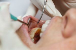 Dentist using tools to work on patients teeth
