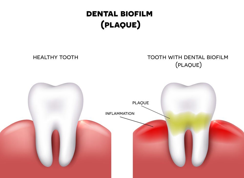 Causes of Periodontal Disease » North Branford Dentist | North Branford ...